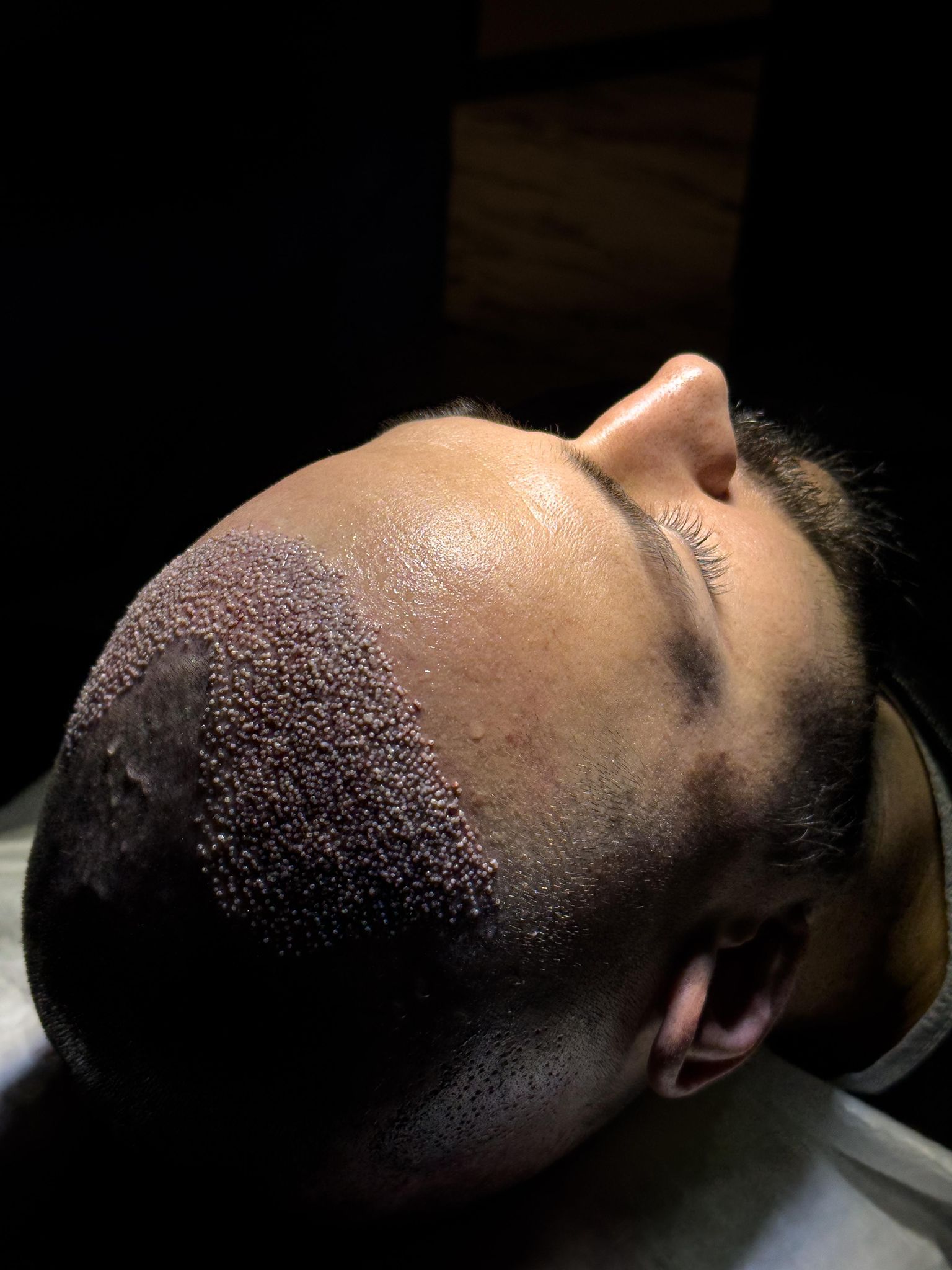 ¿Qué es un implante capilar? Guía clara en 5 minutos